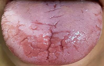 Smooth tongue and glossitis. Common nonspecific oral manifestation associated with IBD. Authors’ archives.