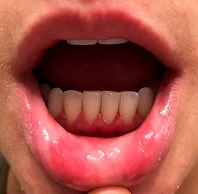 Multiple minor ulcerated lesions compatible with aphthous stomatitis. Authors’ archives.