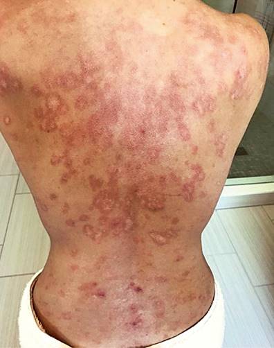 Paradoxical psoriasis secondary to the use of anti-TNF. Authors’ archives.