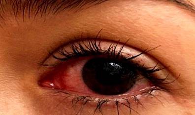 Left eye scleritis. Authors’ archives.