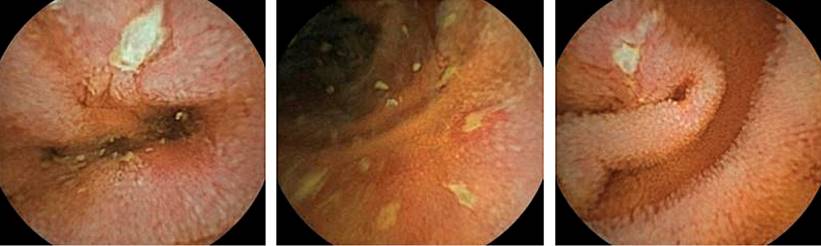 CD enteritis in a capsule endoscopy of the small intestine. Authors’ archives.