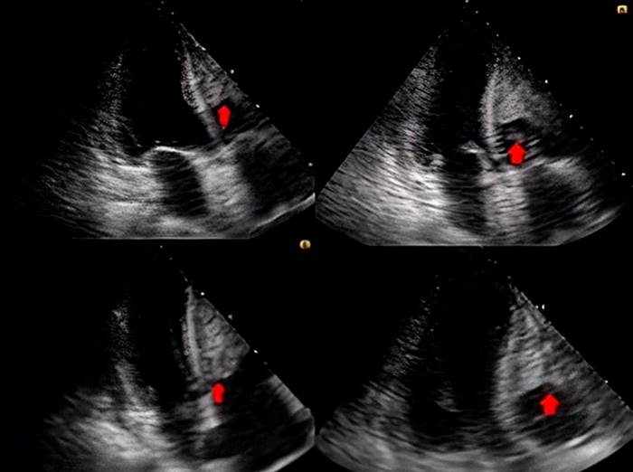 Transthoracic echocardiogram showing a thrombus covering most of the free wall of the right ventricle with another image of the same echogenicity, rounded, 1.6 x 1.6 cm, which oscillated and even protruded through the tricuspid valve. Courtesy of the radiology department, HORO.