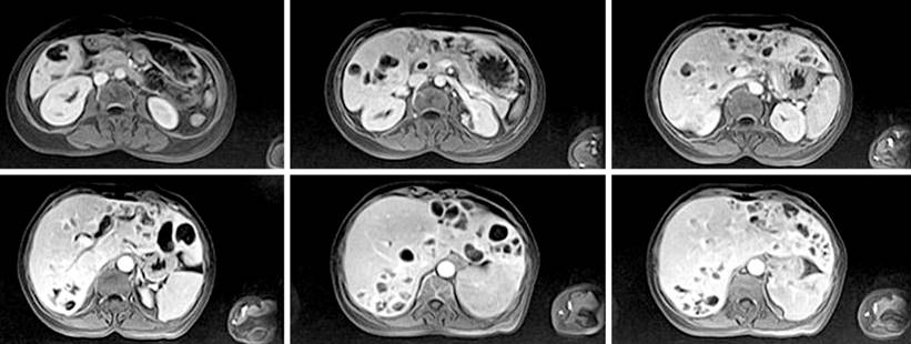 Abdominal resonance of axial and coronal planes. Liver measuring 22 cm in the longitudinal axis, regular borders, having multiple cystic lesions in both liver lobes with annular contrast enhancement. Source: Patient’s medical record.