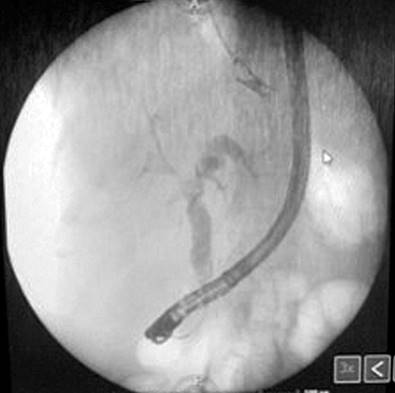 ERCP showing seropurulent content consistent with cholangitis. Source: Patient’s medical record.