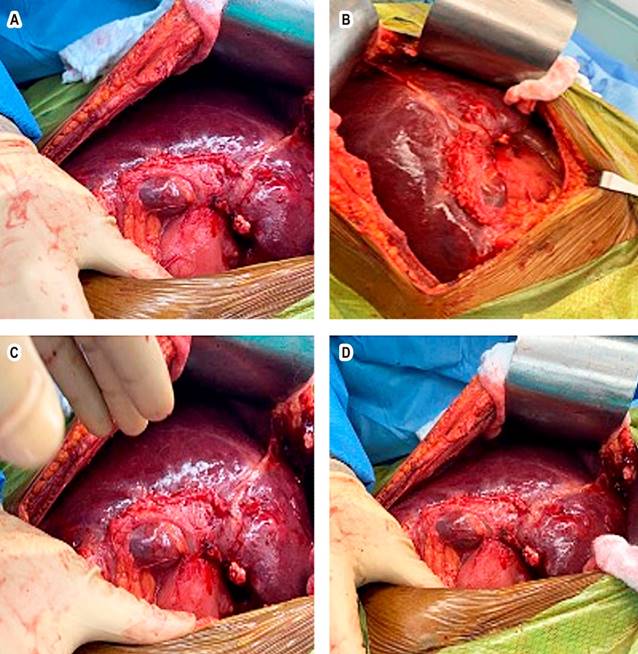 Gross findings on surgical exploration. Cystic areas with whitish, cheesy pasty content. Source: Patient’s medical record.