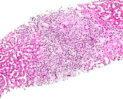 Histological section of liver tissue with giant cell granuloma. Source: Themes U. Mycobacterium tuberculosis11.
