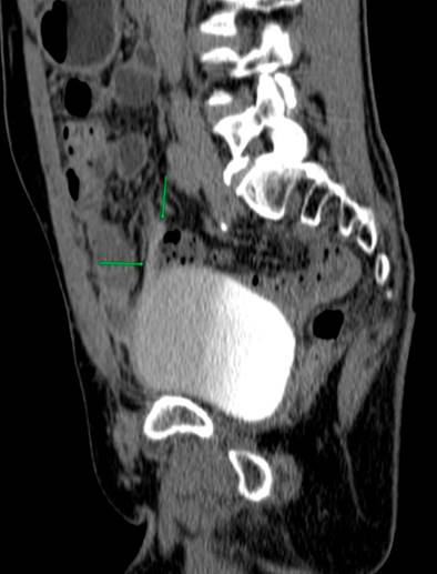 Sagittal section of contrasted urotomography. Green arrows indicate extravasation of contrast medium. Authors’ archives.
