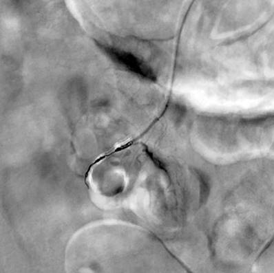Angiographic embolization of the jejunal diverticulum highlighting a cystic figure compatible with a jejunal diverticulum. Source: Hemodynamics Service, Hospital Comuneros. Selected by the authors.