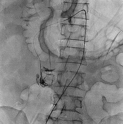 Angiographic embolization of the diverticulum. Source: Hemodynamics Service, Hospital Comuneros. Selected by the authors.