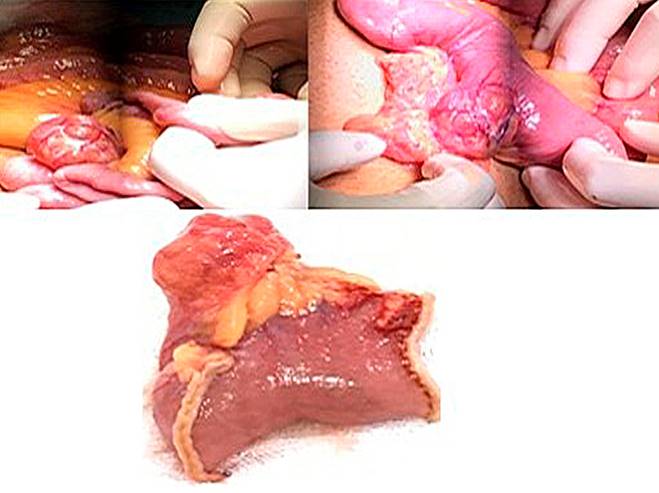 Macroscopic anatomical piece. Presence of an open diverticulum that allows its content to be observed. Source: Surgery Service, Hospital Comuneros. Selected by the authors.