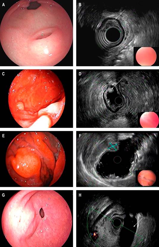 Endoscopic view of SEL of the antrum suggestive of an ectopic pancreas. A. Endosonographic appearance. B. Lesion involving the third echolayer (arrow); endoscopic view of the distal gastric body SEL. C. Endosonographic appearance. D. Third echolayer lesion consistent with a lipoma (arrow); endoscopic view of the gastric body SEL. E. Endosonographic appearance. F. Fourth echolayer lesion suggestive of GIST (dotted lines); endoscopic view of an elevation of a subepithelial appearance of the gastric antrum. G. Endosonographic image. H. Endosonographic image with extrinsic compression of the gallbladder (arrow). Image owned by the authors.