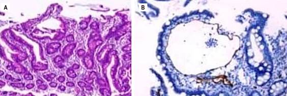 A. Duodenal mucosa. B. Histological sections of duodenal biopsy with podoplanin (D2-40) immunohistochemical staining highlighting lymphatic vascular structures in isolated villi. 