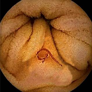 Capsule endoscopy shows red worms in the jejunum. 