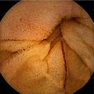 Capsule endoscopy identified hookworms in the patient&rsquo;s small intestine. 