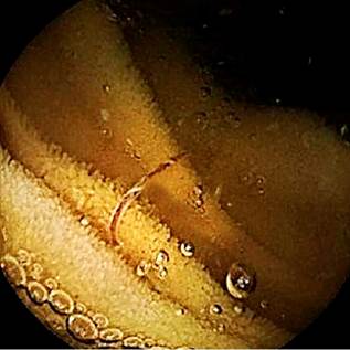 Another image from the capsule endoscopy showing a hookworm in the patient&rsquo;s small intestine. 
