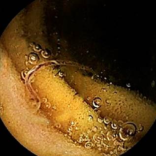 Hookworm in the mucosa of the patient&rsquo;s small intestine. 