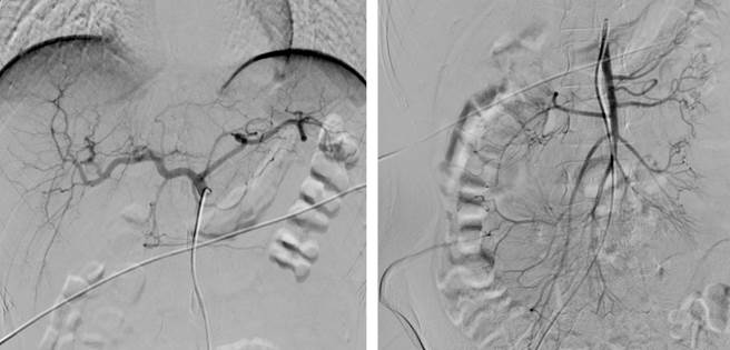 Abdominal aortogram and selective mesenteric vessel study within normal limits for age. 