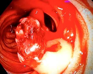Intraoperative enteroscopy. Polypoid lesion in the jejunum with active bleeding. 