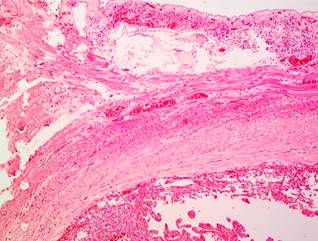 Capillary hemangioma of the jejunum. Hematoxylin-eosin stain, 40x. Involvement of the submucosal and muscularis propria layers. 