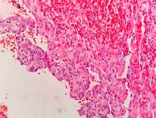 Capillary hemangioma of the jejunum. Hematoxylin-eosin stain, 400x. Thin-walled vascular channels with abundant blood content.