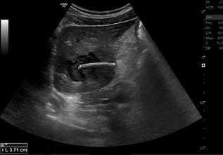 Abdominal ultrasound showing a 3.7 cm linear echogenic structure consistent with a foreign body within, along with an abscess in the left liver lobe. 