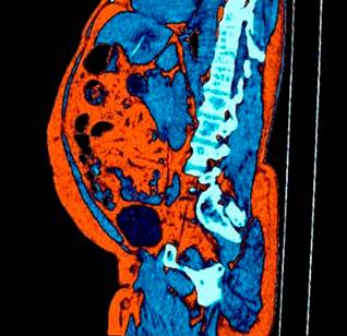 Abdominal CT scan, demonstrating a liver abscess in segments II and III, with a foreign body extending into the adjacent liver parenchyma. 
