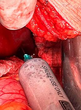 Liver abscess drainage. 