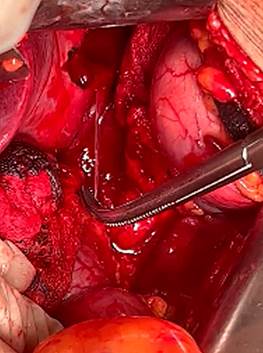 Foreign body (fish bone) removal. 