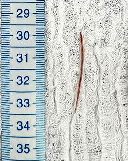 Foreign body (fish bone). 