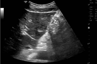 Postoperative liver ultrasound. 