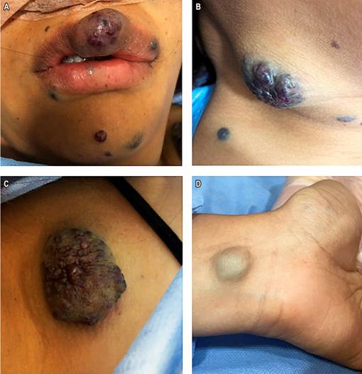 BRBNS in the lip and skin. A. Upper lip and facial area. B. Neck. C. Chest. D. Wrist. Images from the files of Uni�n de Cirujanos S.A.S., Manizales, Colombia, Clinical-Surgical Gastroenterology Service, Universidad de Caldas.