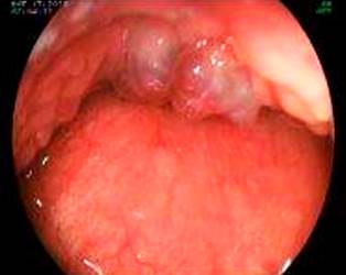 BRBNS at the base of the tongue. Image courtesy of Dr. Fabi�n Eduardo Puentes Manosalva, Uni�n de Cirujanos S.A.S., Manizales, Colombia, Clinical-Surgical Gastroenterology Service, Universidad de Caldas.