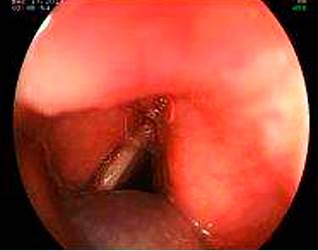 BRBNS in the supraglottic region. Image courtesy of Dr. Fabi�n Eduardo Puentes Manosalva, Uni�n de Cirujanos S.A.S., Manizales, Colombia, Clinical-Surgical Gastroenterology Service, Universidad de Caldas.
