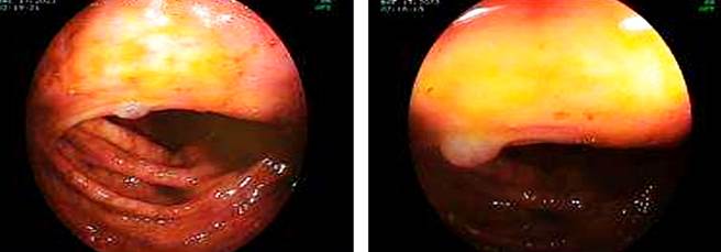 BRBNS in the cecum. Image courtesy of Dr. Fabi�n Eduardo Puentes Manosalva, Uni�n de Cirujanos S.A.S., Manizales, Colombia, Clinical-Surgical Gastroenterology Service, Universidad de Caldas.