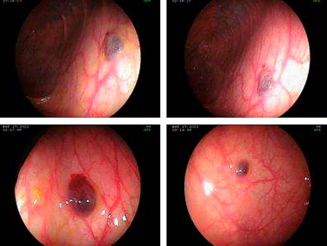 BRBNS in the transverse and descending colon. Images courtesy of Dr. Fabi�n Eduardo Puentes Manosalva, Uni�n de Cirujanos S.A.S., Manizales, Colombia, Clinical-Surgical Gastroenterology Service, Universidad de Caldas.