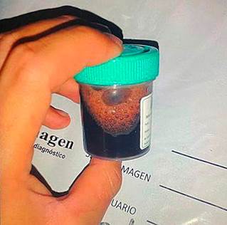 Urine discoloration observed in the patient. 