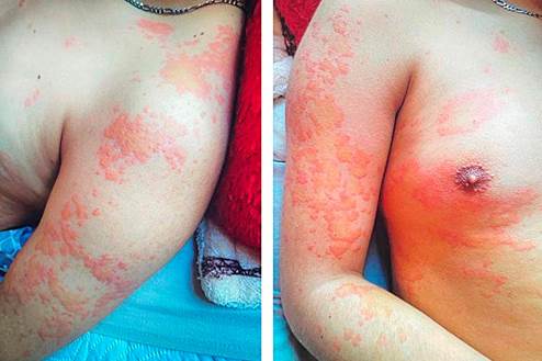 Pruritic skin lesions presenting as erythematous-edematous plaques with central pallor, predominantly on the upper limbs and trunk. 