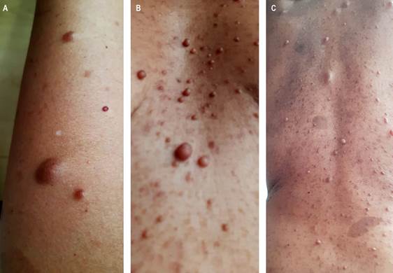 Caf�-au-lait Macules and Neurofibromas on the Skin of a Patient with Neurofibromatosis Type 1. A. Upper limb. B. Abdomen. C. Dorsal region. Images courtesy of Dr. Fabi�n Eduardo Puentes-Manosalva, Uni�n de Cirujanos S. A. S., Clinical-Surgical Gastroenterology Service, Universidad de Caldas, Manizales, Colombia.