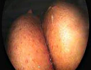 Caf�-au-lait Macules on the Gluteal Region of a Patient with Neurofibromatosis Type 1. Image courtesy of Dr. Fabi�n Eduardo Puentes-Manosalva, Uni�n de Cirujanos S. A. S., Clinical-Surgical Gastroenterology Service, Universidad de Caldas, Manizales, Colombia.