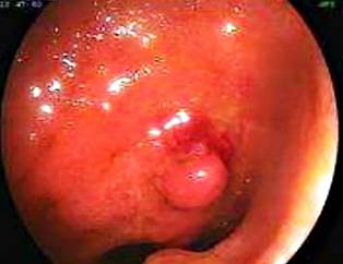 Atypical Nodular Lesion in the Distal Ileum of a Patient with Neurofibromatosis Type 1. Image courtesy of Dr. Fabi�n Eduardo Puentes-Manosalva, Uni�n de Cirujanos S. A. S., Clinical-Surgical Gastroenterology Service, Universidad de Caldas, Manizales, Colombia.