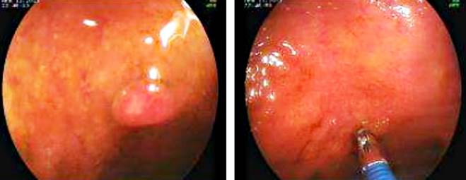 Atypical Nodular Lesion in the Distal Ileum of a Patient with Neurofibromatosis Type 1 and Its Endoscopic Resection. Images courtesy of Dr. Fabi�n Eduardo Puentes-Manosalva, Uni�n de Cirujanos S. A. S., Clinical-Surgical Gastroenterology Service, Universidad de Caldas, Manizales, Colombia.
