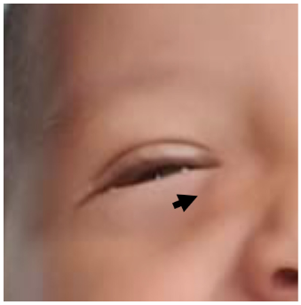Figura 1. Lactante con dacrioestenosis derecha (flecha)