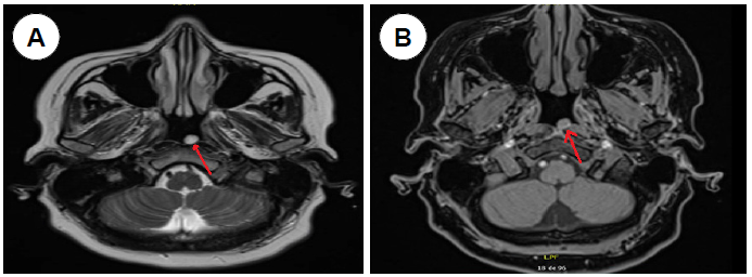 Figura 1. A: RMN corte axial en T1, tumoraci�n en nasofaringe (flecha roja). B: Corte axial en T2, tumoraci�n en nasofaringe (flecha roja).