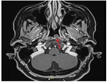 Figura 2. RMN T1 con contraste, tumoraci�n en nasofaringe (flecha roja).
