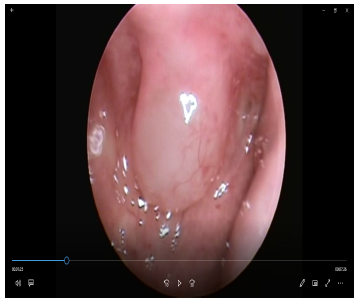 Figura 3. Tumoraci�n en nasofaringe, visi�n por endoscopia nasal.