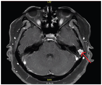 Figura 1. RMN con contraste, se aprecia lesi�n en mastoides izquierda (flecha roja).