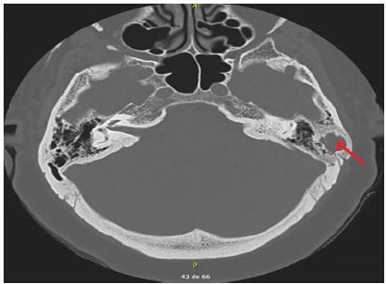 Figura 2. Tomograf�a corte axial, se aprecia tumoraci�n en mastoides izquierda (flecha roja).