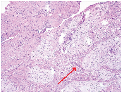 Figura 3. Se aprecia tejido fibr�tico con c�lulas espumosas (flecha roja).