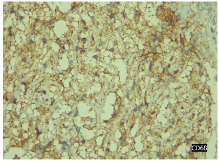 Figura 4. Con estudio CD 68 siendo negativo para Histiocitosis.