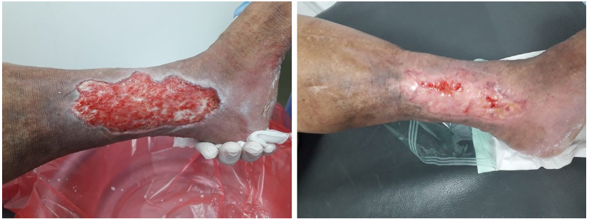 Manejo de lcera varicosa incluye educacin del paciente, tratamiento mdico, terapia de compresin y tratamiento quirrgico/endovenoso